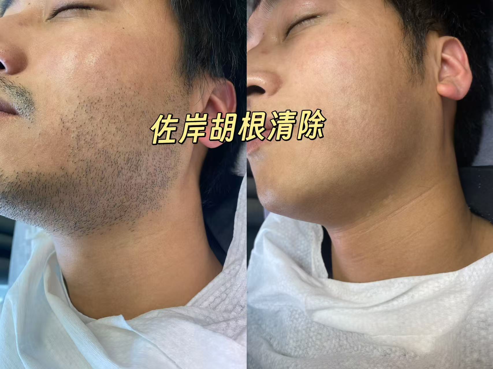 嘉兴脱胡子